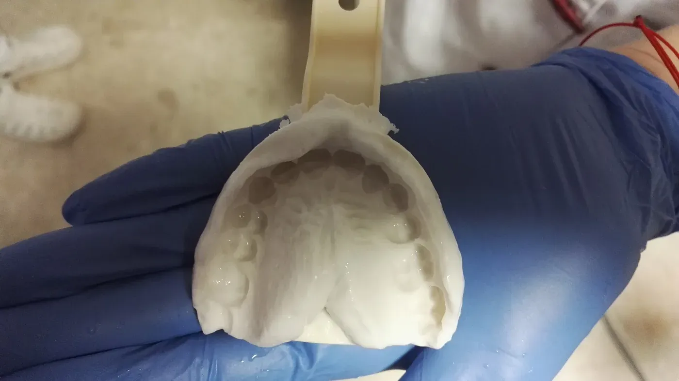 A gloved hand holding a pale pink dental impression tray filled with a set, tooth-imprinted alginate mold showing the detailed shape of a row of upper teeth.